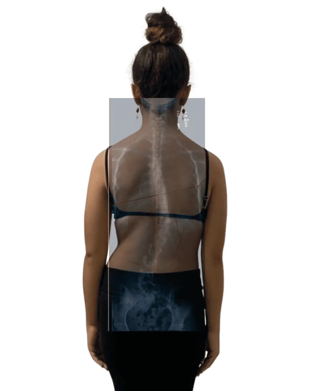 colete 3D Schroth sem colete 3d Schroth e com rx