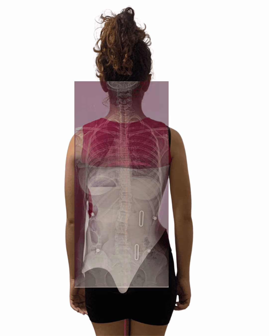 colete 3D Schroth correção no colete 3d Schroth
